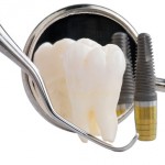 Zahn-Implantate bei Diabetikern